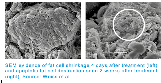 Image of fat cell shrinkage and apoptotic fat cell destruction.